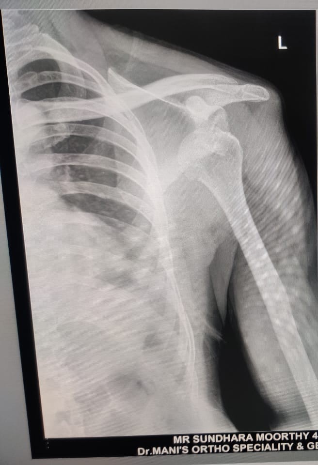 Before joint replacement example